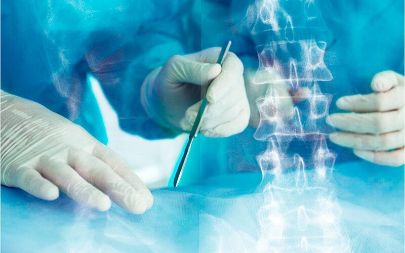 Cirurgia de hérnia de disco lombar