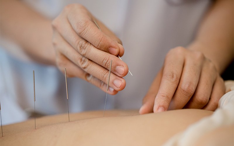 Acupuntura