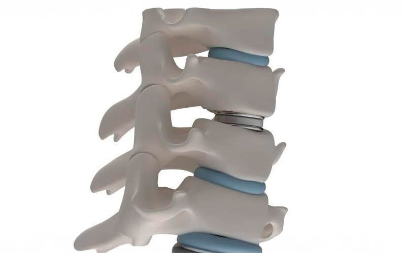 Prótese de disco cervical